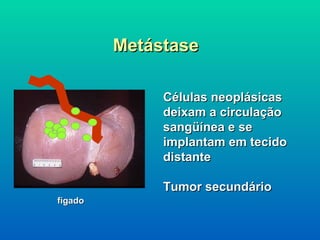 Metástase fígado Células neoplásicas deixam a circulação sangüínea e se implantam em tecido distante Tumor secundário 