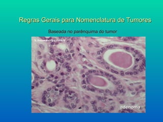 Regras Gerais para Nomenclatura de Tumores Baseada no parênquima do tumor adenoma 