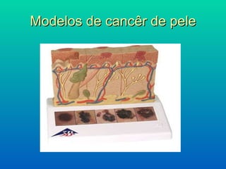 Modelos de cancêr de pele 