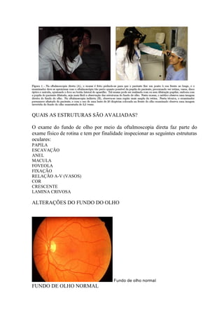 QUAIS AS ESTRUTURAS SÃO AVALIADAS?
O exame do fundo de olho por meio da oftalmoscopia direta faz parte do
exame físico de rotina e tem por finalidade inspecionar as seguintes estruturas
oculares:
PAPILA
ESCAVAÇÃO
ANEL
MACULA
FOVEOLA
FIXAÇÃO
RELAÇÃO A-V (VASOS)
COR
CRESCENTE
LAMINA CRIVOSA
ALTERAÇÕES DO FUNDO DO OLHO
Fundo de olho normal
FUNDO DE OLHO NORMAL
 