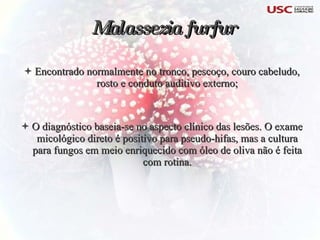 Encontrado normalmente no tronco, pescoço, couro cabeludo, rosto e conduto auditivo externo; O diagnóstico baseia-se no aspecto clínico das lesões. O exame micológico direto é positivo para pseudo-hifas, mas a cultura para fungos em meio enriquecido com óleo de oliva não é feita com rotina. Malassezia furfur 