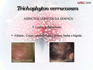 ASPECTOS CLÍNICOS DA DOENÇA Lesões inflamatórias Afetam : Couro cabeludo, pele, glabra, barba e bigode. Trichophyton verrucosum   