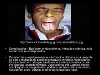 http://www.clinicando.hpg.ig.com.br/candidiase.jpg Complicações - Esofagite, endocardite, ou infecção sistêmica, mais comum em imunodeprimidos.  Características epidemiológicas - A Candida albicans está presente na pele e mucosas de pessoas saudáveis. Infecção mucocutânea leve é comum em crianças saudáveis e a doença invasiva ocorre em pessoas imunodeprimidas. Vulvovaginite por Candida ocorre com freqüência em gestantes, podendo ser transmitida ao recém-nascido em útero, durante o parto ou na fase pós-natal. 