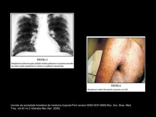 (revista da sociedade brasileira de medicina tropical- Print version  ISSN 0037-8682-Rev. Soc. Bras. Med. Trop. vol.42 no.2 Uberaba Mar./Apr. 2009) 