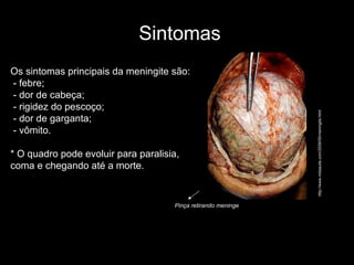 Os sintomas principais da meningite são:   - febre;  - dor de cabeça;  - rigidez do pescoço;  - dor de garganta;  - vômito.   * O quadro pode evoluir para paralisia, coma e chegando até a morte. Sintomas Pinça retirando meninge  http://www.mdsaude.com/2009/05/meningite.html 