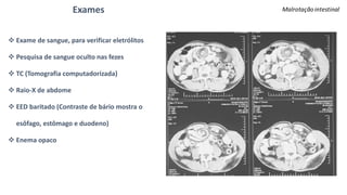 Exames
 Exame de sangue, para verificar eletrólitos
 Pesquisa de sangue oculto nas fezes
 TC (Tomografia computadorizada)
 Raio-X de abdome
 EED baritado (Contraste de bário mostra o
esôfago, estômago e duodeno)
 Enema opaco
 