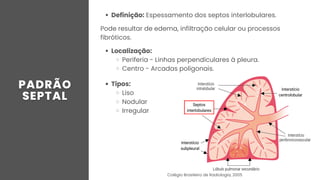 Definição: Espessamento dos septos interlobulares.
Pode resultar de edema, infiltração celular ou processos
fibróticos.
Localização:
Periferia - Linhas perpendiculares à pleura.
Centro - Arcadas poligonais.
Septos
interlobulares
Interstício
subpleural
Interstício
centrolobular
Tipos:
Liso
Nodular
Irregular
Colégio Brasileiro de Radiologia, 2005
 