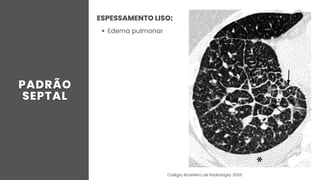 ESPESSAMENTO LISO:
Edema pulmonar
Colégio Brasileiro de Radiologia, 2005
 