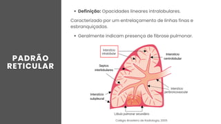 Definição: Opacidades lineares intralobulares.
Caracterizado por um entrelaçamento de linhas finas e
esbranquiçadas.
Geralmente indicam presença de fibrose pulmonar.
Septos
interlobulares
Interstício
subpleural
Interstício
centrolobular
Colégio Brasileiro de Radiologia, 2005
 
