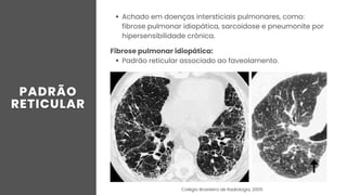 Achado em doenças intersticiais pulmonares, como:
fibrose pulmonar idiopática, sarcoidose e pneumonite por
hipersensibilidade crônica.
Fibrose pulmonar idiopática:
Padrão reticular associado ao faveolamento.
Colégio Brasileiro de Radiologia, 2005
 