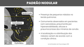 Presença de pequenos nódulos no
tecido pulmonar.
Comumente observados em pacientes
com sarcoidose, pneumonite por
hipersensibilidade, silicose e
pneumoconiose dos mineiros de carvão.
A localização e a distribuição dos
nódulos variam de acordo com a
condição clínica.
PADRÃO NODULAR
Centrolobular
Randomizado
Perilinfático Jornal Brasileiro de Pneumologia, 2019
 