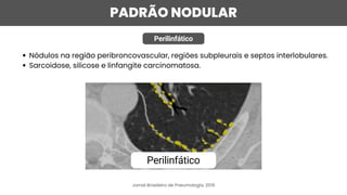 PADRÃO NODULAR
Perilinfático
Nódulos na região peribroncovascular, regiões subpleurais e septos interlobulares.
Sarcoidose, silicose e linfangite carcinomatosa.
Jornal Brasileiro de Pneumologia, 2019
Perilinfático
 