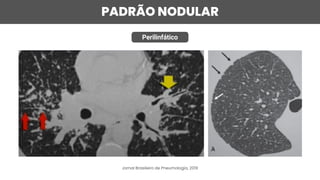 PADRÃO NODULAR
Perilinfático
Jornal Brasileiro de Pneumologia, 2019
 