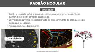 PADRÃO NODULAR
Centrolobular
Região composta pelos bronquíolos terminais, pelos ramos das artérias
pulmonares e pelos alvéolos adjacentes.
Na maioria das vezes está relacionado ao preenchimento de bronquíolos por
muco, pus ou sangue.
Padrão em árvore brotamento.
Jornal Brasileiro de Pneumologia, 2017
Centrolobular
 