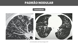 PADRÃO NODULAR
Centrolobular
Jornal Brasileiro de Pneumologia, 2017
 