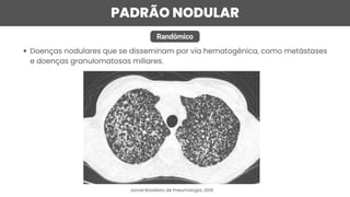 PADRÃO NODULAR
Randômico
Doenças nodulares que se disseminam por via hematogênica, como metástases
e doenças granulomatosas miliares.
Jornal Brasileiro de Pneumologia, 2019
 
