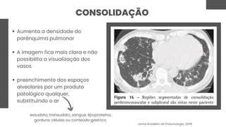 CONSOLIDAÇÃO
Aumenta a densidade do
parênquima pulmonar
A imagem fica mais clara e não
possibilita a visualização dos
vasos
preenchimento dos espaços
alveolares por um produto
patológico qualquer,
substituindo o ar
exsudato, transudato, sangue, lipoproteína,
gordura, células ou conteúdo gástrico
Jornal Brasileiro de Pneumologia, 2008
 