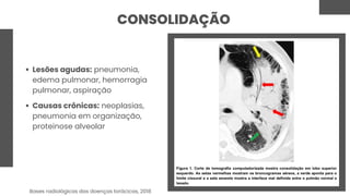 CONSOLIDAÇÃO
Lesões agudas: pneumonia,
edema pulmonar, hemorragia
pulmonar, aspiração
Causas crônicas: neoplasias,
pneumonia em organização,
proteinose alveolar
Bases radiológicas das doenças torácicas, 2018
 