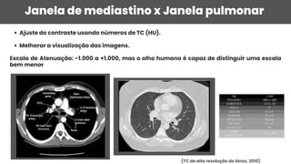 Ajuste do contraste usando números de TC (HU).
Melhorar a visualização das imagens.
Escala de Atenuação: -1.000 a +1.000, mas o olho humano é capaz de distinguir uma escala
bem menor
Janela de mediastino x Janela pulmonar
(TC de alta resolução do tórax, 2010)
 
