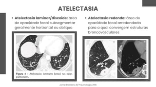 ATELECTASIA
Atelectasia laminar/discoide: área
de opacidade focal subsegmentar
geralmente horizontal ou oblíqua
Atelectasia redonda: área de
opacidade focal arredondada
para a qual convergem estruturas
broncovasculares
Jornal Brasileiro de Pneumologia, 2010
 