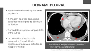 DERRAME PLEURAL
Acúmulo anormal de líquido entre
as pleuras
A imagem aparece como uma
opacidade na região de acúmulo
de líquido
Transudato, exsudato, sangue, linfa,
entre outros
Os transudatos estão mais
associados à insuficiência
cardíaca congestiva e estados de
hipoproteinemia
D: derrame e espessamento pericárdico
P: derrame pleural bilateral
Bases radiológicas das doenças torácicas, 2018
 