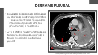 DERRAME PLEURAL
Exsudatos decorrem de inflamação
ou alteração de drenagem linfática
- mais encontrados nos quadros
infecciosos (mais de 50% das
pneumonias) e neoplasias
A TC é efetiva na demonstração do
tamanho, distribuição, extensão e
lesões associadas ao derrame
pleural
Bases radiológicas das doenças torácicas, 2018
 