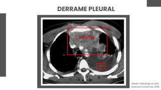 DERRAME PLEURAL
Bases radiológicas das
doenças torácicas, 2018
 