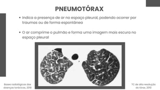 PNEUMOTÓRAX
Indica a presença de ar no espaço pleural, podendo ocorrer por
traumas ou de forma espontânea
O ar comprime o pulmão e forma uma imagem mais escura no
espaço pleural
TC de alta resolução
do tórax, 2010
Bases radiológicas das
doenças torácicas, 2018
 
