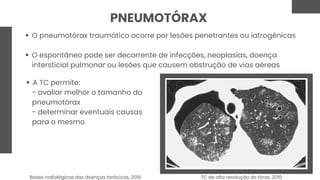 PNEUMOTÓRAX
O pneumotórax traumático ocorre por lesões penetrantes ou iatrogênicas
O espontâneo pode ser decorrente de infecções, neoplasias, doença
intersticial pulmonar ou lesões que causem obstrução de vias aéreas
A TC permite:
- avaliar melhor o tamanho do
pneumotórax
- determinar eventuais causas
para o mesmo
TC de alta resolução do tórax, 2010
Bases radiológicas das doenças torácicas, 2018
 