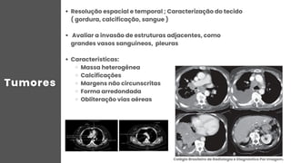 Resolução espacial e temporal ; Caracterização do tecido
( gordura, calcificação, sangue )
Avaliar a invasão de estruturas adjacentes, como
grandes vasos sanguíneos, pleuras
Características:
Massa heterogênea
Calcificações
Margens não circunscritas
Forma arredondada
Obliteração vias aéreas
Colégio Brasileiro de Radiologia e Diagnóstico Por Imagem.
 