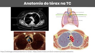 Anatomia do tórax na TC
https://radiologia.online/anatomia-tc-torax/ ; https://www.imaios.com/br/e-anatomy/torax/mediastino
 