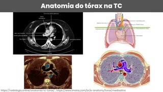 Anatomia do tórax na TC
https://radiologia.online/anatomia-tc-torax/ ; https://www.imaios.com/br/e-anatomy/torax/mediastino
 