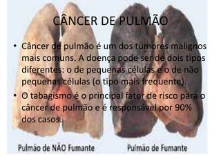 CÂNCER DE PULMÃO
• Câncer de pulmão é um dos tumores malignos
mais comuns. A doença pode ser de dois tipos
diferentes: o de pequenas células e o de não
pequenas células (o tipo mais frequente).
• O tabagismo é o principal fator de risco para o
câncer de pulmão e é responsável por 90%
dos casos.

 