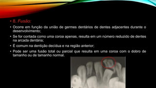• 8. Fusão:
• Ocorre em função da união de germes dentários de dentes adjacentes durante o
desenvolvimento;
• Se for contada como uma coroa apenas, resulta em um número reduzido de dentes
na arcada dentária;
• É comum na dentição decídua e na região anterior;
• Pode ser uma fusão total ou parcial que resulta em uma coroa com o dobro de
tamanho ou de tamanho normal.
 