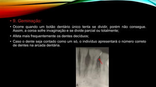 • 9. Geminação:
• Ocorre quando um botão dentário único tenta se dividir, porém não consegue.
Assim, a coroa sofre invaginação e se divide parcial ou totalmente;
• Afeta mais frequentemente os dentes decíduos;
• Caso o dente seja contado como um só, o indivíduo apresentará o número correto
de dentes na arcada dentária.
 