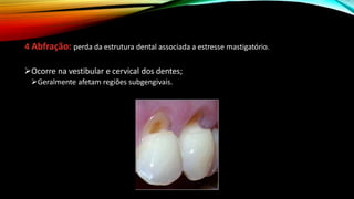 4 Abfração: perda da estrutura dental associada a estresse mastigatório.
➢Ocorre na vestibular e cervical dos dentes;
➢Geralmente afetam regiões subgengivais.
 