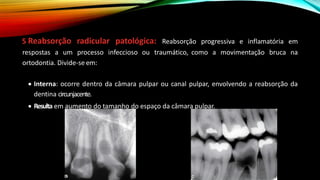 5 Reabsorção radicular patológica: Reabsorção progressiva e inflamatória em
respostas a um processo infeccioso ou traumático, como a movimentação bruca na
ortodontia. Divide-se em:
• Interna: ocorre dentro da câmara pulpar ou canal pulpar, envolvendo a reabsorção da
dentina circunjacente.
• Resulta em aumento do tamanho do espaço da câmara pulpar.
 