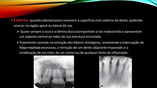 • Externa: quando odontoclastos removem a superfície mais externa do dente, podendo
ocorrer na região apical ou lateral da raiz.
➢ Quase sempre o osso e a lâmina dura acompanham a raiz reabsorvida e apresentam
um aspecto normal ao redor de sua estrutura encurtada.
➢Tratamento consiste na remoção dos fatores etiológicos, envolvendo a interrupção de
forçasmecânicasexcessivas, a remoção de um dente adjacente impactado e a
erradicação de um cisto, de um tumor ou de qualquer fonte de inflamação.
 