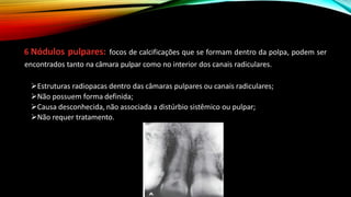 6 Nódulos pulpares: focos de calcificações que se formam dentro da polpa, podem ser
encontrados tanto na câmara pulpar como no interior dos canais radiculares.
➢Estruturas radiopacas dentro das câmaras pulpares ou canais radiculares;
➢Não possuem forma definida;
➢Causa desconhecida, não associada a distúrbio sistêmico ou pulpar;
➢Não requer tratamento.
 