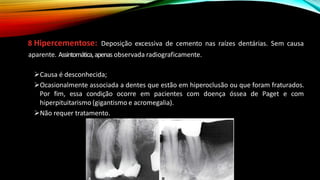 8 Hipercementose: Deposição excessiva de cemento nas raízes dentárias. Sem causa
aparente. Assintomática,apenas observada radiograficamente.
➢Causa é desconhecida;
➢Ocasionalmente associada a dentes que estão em hiperoclusão ou que foram fraturados.
Por fim, essa condição ocorre em pacientes com doença óssea de Paget e com
hiperpituitarismo (gigantismo e acromegalia).
➢Não requer tratamento.
 