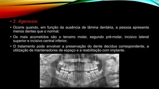 • 2. Agenesia:
• Ocorre quando, em função da ausência de lâmina dentária, a pessoa apresenta
menos dentes que o normal;
• Os mais acometidos são o terceiro molar, segundo pré-molar, incisivo lateral
superior e incisivo central inferior;
• O tratamento pode envolver a preservação do dente decíduo correspondente, a
utilização de mantenedores de espaço e a reabilitação com implante.
 
