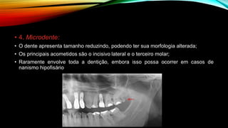• 4. Microdente:
• O dente apresenta tamanho reduzindo, podendo ter sua morfologia alterada;
• Os principais acometidos são o incisivo lateral e o terceiro molar;
• Raramente envolve toda a dentição, embora isso possa ocorrer em casos de
nanismo hipofisário
 