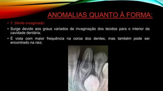 ANOMALIAS QUANTO À FORMA:
• 7. Dente invaginado:
• Surge devido aos graus variados de invaginação dos tecidos para o interior da
cavidade dentária;
• É vista com maior frequência na coroa dos dentes, mas também pode ser
encontrado na raiz;
 