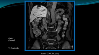 Corte 
Coronal 
T1- Anatomia 
Fonte: GOOGLE, 2014 
 