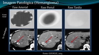 Imagem Patológica (Hemangioma) 
Fase Arterial Fase Portal Fase Tardia 
Fonte: GOOGLE, 2014 
Corte 
Axial 
 