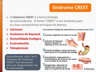 Síndrome CREST
» A síndrome CREST é a forma limitada
da escleroderma. O termo "CREST" é um acrônimo para
as cinco características principais da doença:
» Calcinose
» Fenômeno de Raynaud
» Dismotilidade Esofágica
» Esclerodactilia
» Telangiectasia
Generalmente, solo 2 de 5
síntomas del síndrome
CREST son necesarios
para ser diagnosticado con
la enfermedad.
 