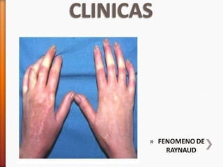 » FENOMENO DE
RAYNAUD
 