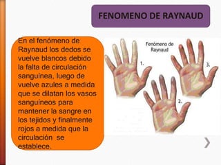 En el fenómeno de
Raynaud los dedos se
vuelve blancos debido
la falta de circulación
sanguínea, luego de
vuelve azules a medida
que se dilatan los vasos
sanguíneos para
mantener la sangre en
los tejidos y finalmente
rojos a medida que la
circulación se
establece.
FENOMENO DE RAYNAUD
 