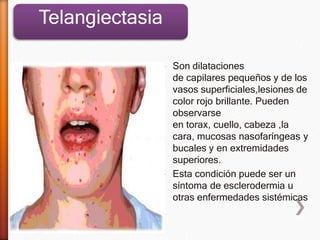 » Son dilataciones
de capilares pequeños y de los
vasos superficiales,lesiones de
color rojo brillante. Pueden
observarse
en torax, cuello, cabeza ,la
cara, mucosas nasofaríngeas y
bucales y en extremidades
superiores.
» Esta condición puede ser un
síntoma de esclerodermia u
otras enfermedades sistémicas
Telangiectasia
 