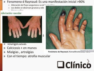 » Fenomeno d Raynaud: Es una manifestación inicial >90%
□ Alteración del flujo sanguineo o a estímulos fríos
□ Los dedos se observan gruesos y edematosos
□ Meses o años
□ Rigida
□ Hipo/hiperpigmentación
» Palidez
» Cianosis
» Parestesias
» Dolor de dedos afectados
» Isquemia en casos avanzados
» Microinfartos en pulpejos
» Telangectasias
» Calcicosis + en manos
» Mialgias , artralgias
» Con el tiempo: atrofia muscular
 